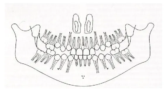 Fig. 2 – Esquema da condição oral de uma criança de 12 anos (adaptado de Barbería  Leache, E