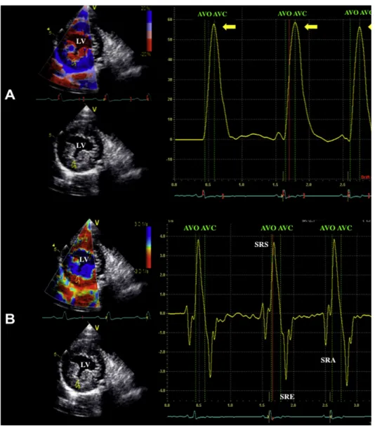 Figure 3 - Examples of normal regional radial strain (A) and strain rate (B) profiles recorded within the left  ventricular  free  wall  in  a  healthy  dog  (right  parasternal  transventricular  short-axis  view)