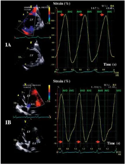 Figure 4 - Examples of radial  (1A) and longitudinal (1B) strain profiles obtained from 2 dogs with dilated  cardiomyopathy  during  3  cardiac  cycles