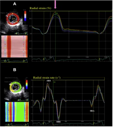 Figure  5  -  Examples  of  normal  left  ventricular  radial  strain  (A)  and  strain  rate  (B)  profiles  recorded  in  6  myocardial  segments  using  2D-STE  in  a  dog  (right  parasternal  transventricular  short-axis  view)