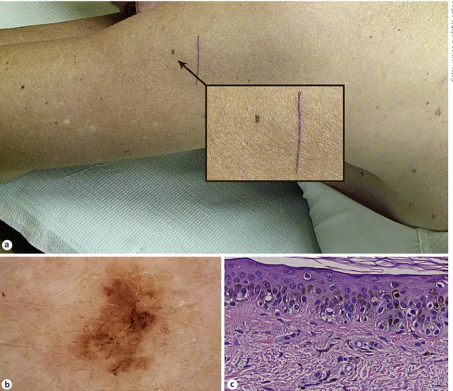 Fig. 2.  Lentigo maligna.  a  Hyperpigmented patch, 3 mm in diameter, on the left arm, in a photo-damaged area,  of a woman in her sixties