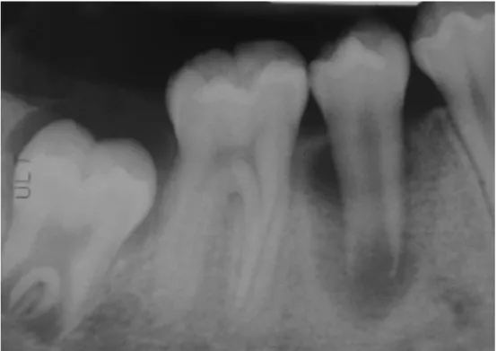 Figura 1- Radiografia pré-operatória. Segundo pré-molar tem uma grande lesão periradicular  radiolúcida no ápice aberto (Banchs &amp; Trope, 2004) 