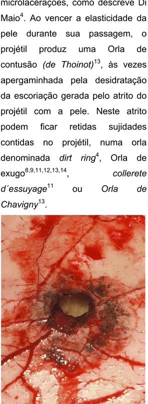 Figura 4.  Sinal do “Schusskanol”. Notar  a impregnação do GSR nas paredes do  trajeto produzido pelo projétil na lâmina  interna  do  crânio