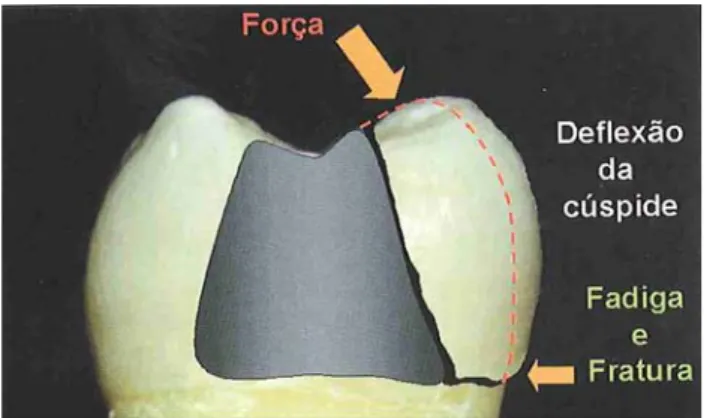 Figura 1 - Distribuição das forças mastigatórias no dente após remoção de estrutura  dentária
