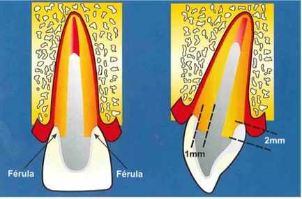 Figura 2 - Efeito de férula. 