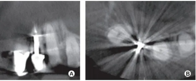 Fig. 1 –  Cortes Coronal (A) e Axial (B) de CBCT através de um incisivo central maxilar restaurado com uma coroa com espigão  retentivo