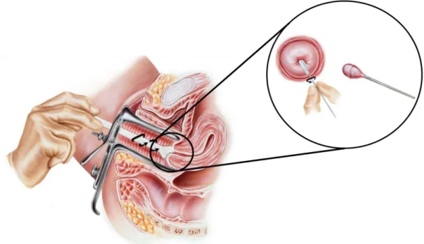 Figura  3.  Citologia  cervico-vaginal  (Adaptado  de  Woodlands  Gynecology  &amp; 