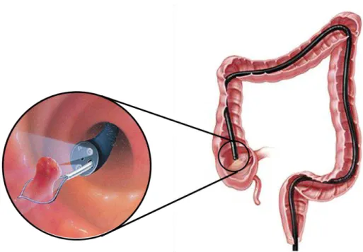 Figura  12.  Colonoscopia.  Remoção  de  um  pólipo  (à  esquerda)  (Adaptado  de  Drugs.com, 2014;  Johns Hopkins Medicine Colorectal Cancer, 2014)