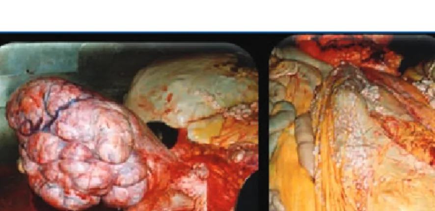 Figura 6. Tumor maligno das células da granulosa, com um tamanho que ultra- ultra-passa largamente o do útero (à esquerda)
