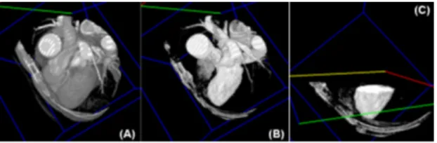 Fig 2. Manually separated line between left ventricle and  the aorta 