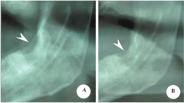 Ilustração  1-  Imagem  raio-x  da  mandíbula.  Imagem  A:  ORN;  Imagem  B:  Evolução  da  ORN,  após  6  meses do uso de pentoxifilina com vitamina E e clodronato ( Delanian.; Depondt; Lefaix, 2005)