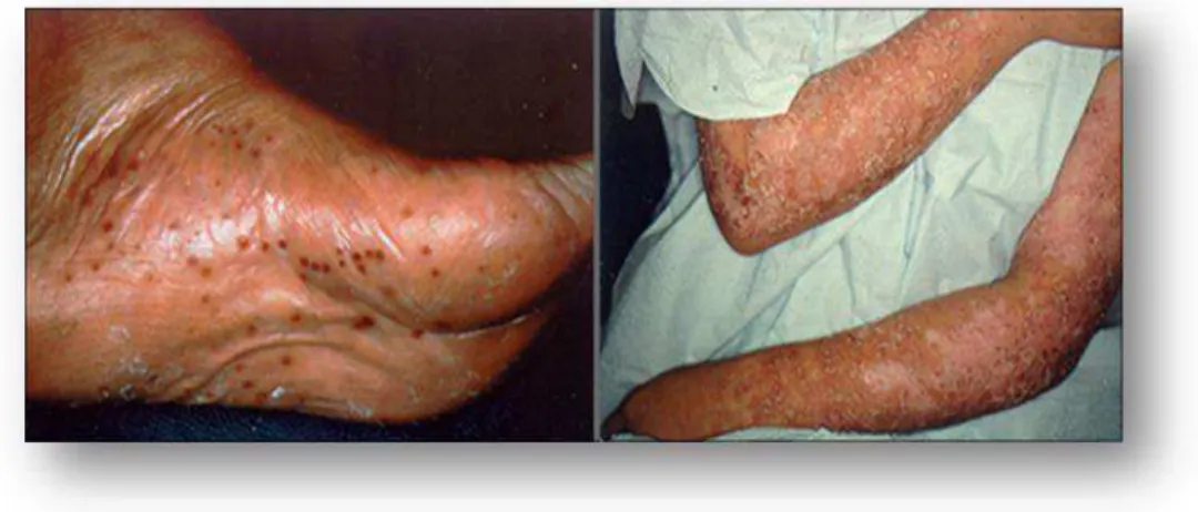 Figura 7: Lesões típicas de psoríase pustular (adaptado de National Psoriasis  Foundation (2014))