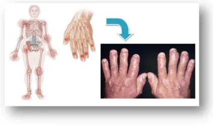Figura 9: Locais e aspeto visual mais comum da artrite psoriática (adaptado de Johns  Hopkins Arthritis Center (2014))