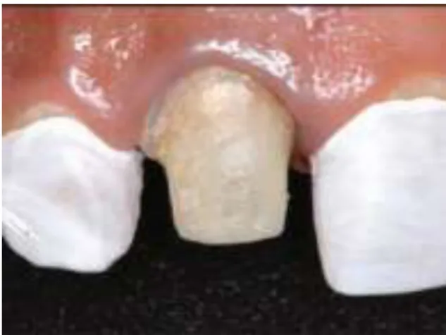 Figura 2: Proteção dos dentes adjacentes, neste caso, com fita teflon (Santos, 2009). 