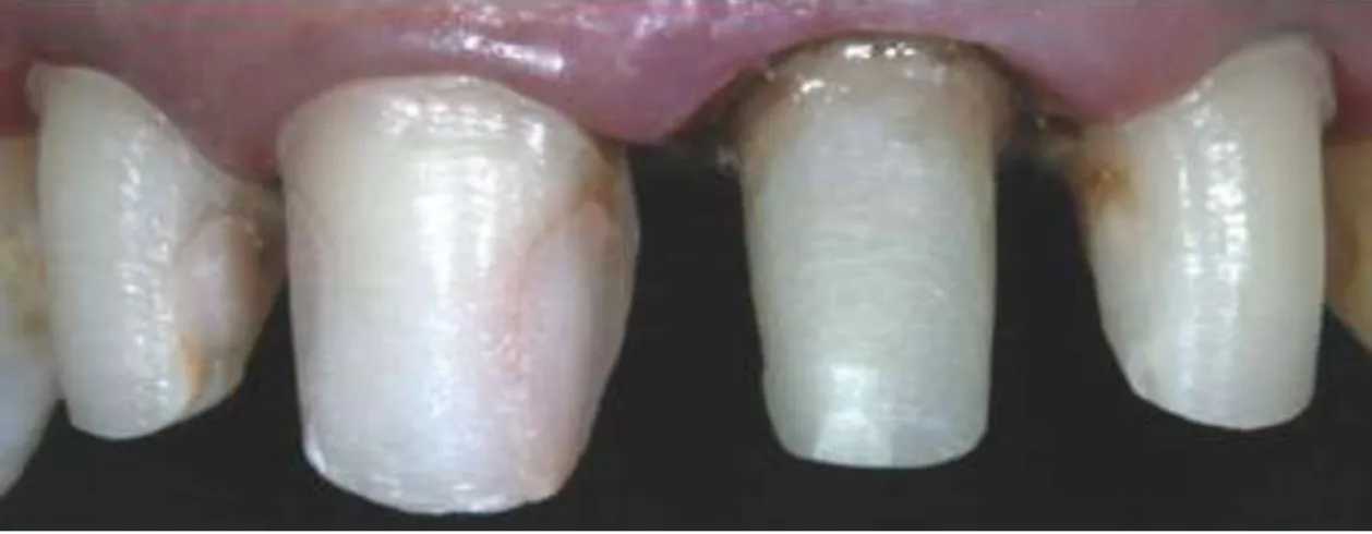 Figura 8: Após as reduções dentárias prévias à colocação de facetas laminadas (incisivo central e lateral  direito) (Anchieta et al., 2011)