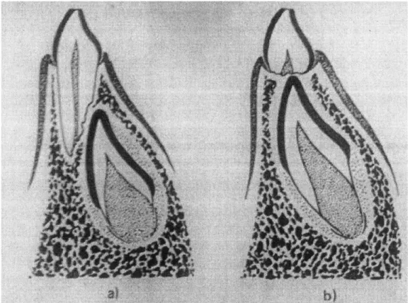 Figure 2: Diagram of exfoliation process of deciduous teeth, adapt (Aknin, 2007). 