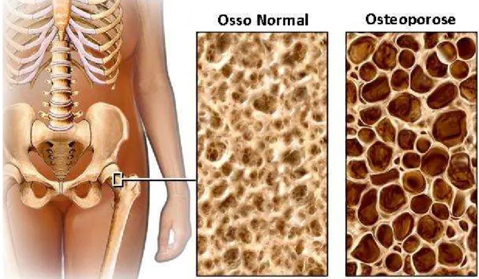 Figura 3.4 - Foto de osso normal e osso com osteoporose[40]. 