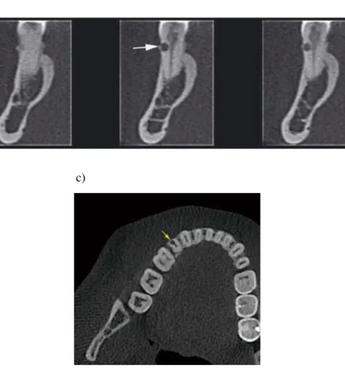 Figura 4: Tomografia computorizada cone beam. a) cortes sagitais. b) Cortes  coronais evidenciando que a RCE não penetrou no canal radicular