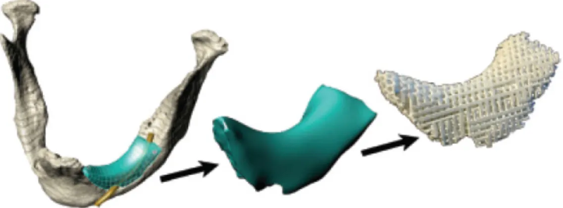 Figura 3. 13 - A seqüência de imagens representa os passos de processamento requeridos  para otimizar o scaffold de hidroxiapatita (HAp) que foi ajustado na parte danificada da  mandíbula do paciente: A imagem obtida da mandíbula danificada por tomografia 