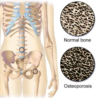 Figure 2.5 [11] – Representation of the architectural structure of normal bone compared with an  osteoporotic bone and the most common occurrences of osteoporosis