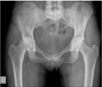 Figure 3.3 – Hip X-ray radiograph displaying bone in a much brighter colour than its surrounding  tissue 