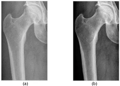 Figure 7.3 – (a) Original femur radiograph (b) Femur radiograph after pre-processing steps of  brightness decrease and contrast adjustment