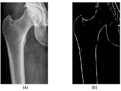 Figure 7.4 – (a) Femur radiograph with contrast adjustment (b) Binary image with the union of  thresholded points for the horizontal and vertical gradient