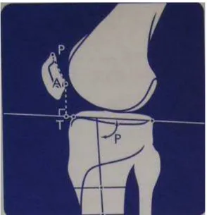 FIGURA 3 – Desenho do joelho mostrando o ângulo  que  corresponde  à  inclinação  tibial  (P)  vista  na  incidência em perfil