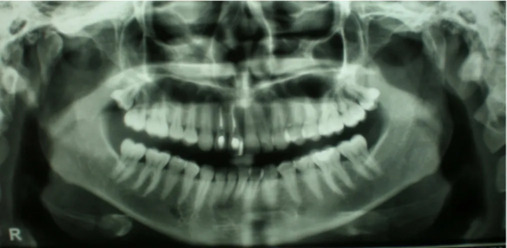 Figura 7: Radiografia panorâmica pré-operatória