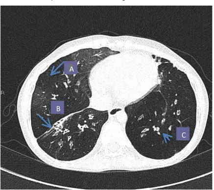 FIGURA  7  –  Tomografia  de  bronquiolite  obliterante  pós-infecciosa diagnosticada há 10 anos 