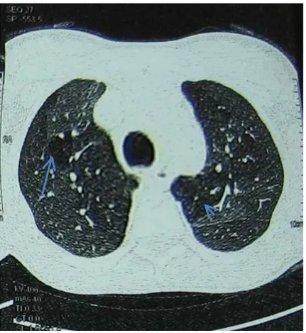 FIGURA  9  -  Tomografia  de  tórax  com  corte  em  expiração,  demonstrando  aprisionamento  aéreo, da mesma criança da FIG