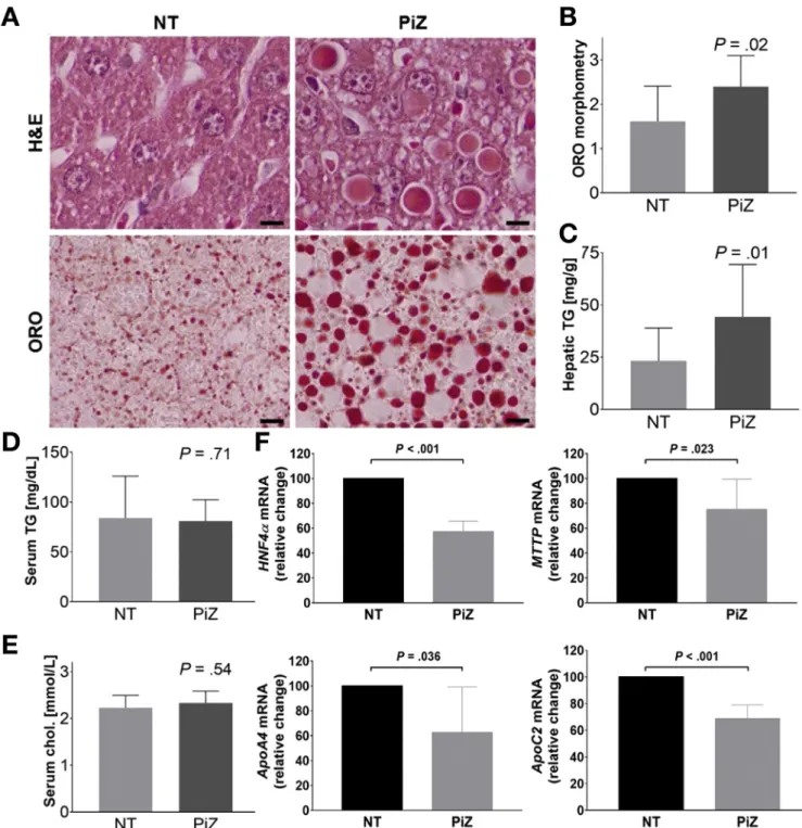 Figure 4. Extent of liver steatosis and expression of steatosis-related genes in untreated mice overexpressing the AAT Pi*Z variant (PiZ) and their non-transgenic littermates (NT)