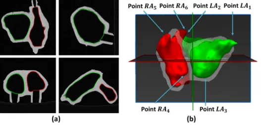 Figure 6 - (a) CT image with manual delineated contours. (b) 3D surface of the left and right atrium and representation  of the manual landmarks required to perform the surface alignment