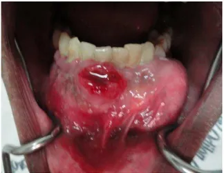 FIGURA  1  -  Aspécto  clínico  intra  oral  da  lesão  evidenciando  áreas ulceradas e expansão das corticais.