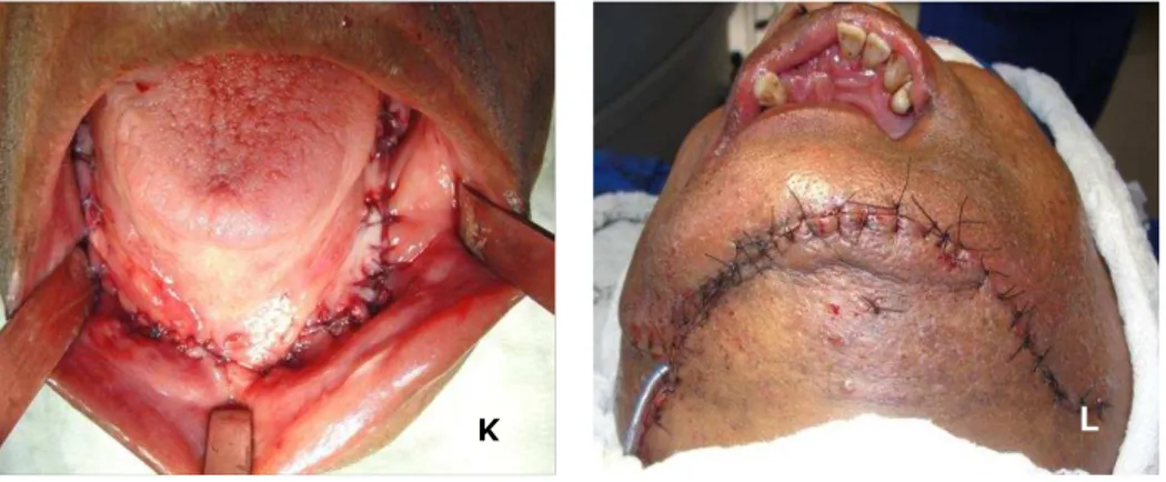FIGURA 5 K: sutura intra oral; L: sutura extra oral 