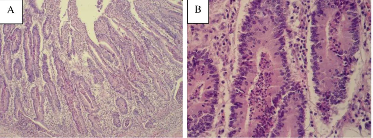 Figura 1.3: Microfotografia de lesão histológica  típica de EP, caracterizada por proliferação de  células epiteliais de criptas intestinais e ausência de células caliciformes