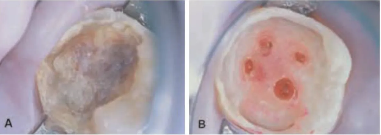 Figura 4. Apresentação clínica de um molar mandibular com lesão cariosa extensa, antes (A) e após  completa remoção da dentina cariada, resultando em 4 exposições pulpares (B) (Adaptado de Bogen,  2008).
