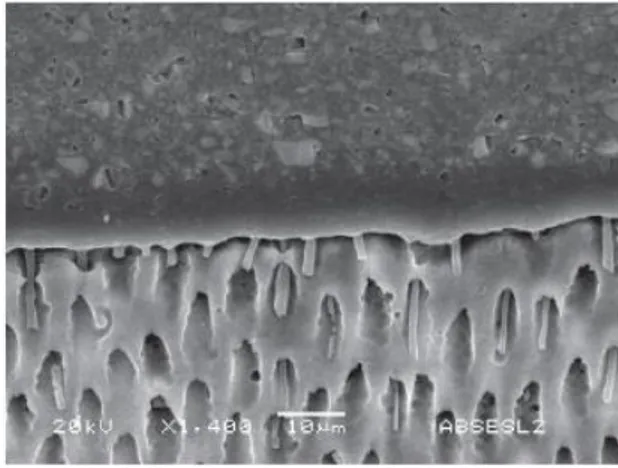 Fig. 11. Quando um agente Self-etch suave, como All Bond SE (pH 2.2) é usado, são  produzidos tags de resina curtos e cilíndricos