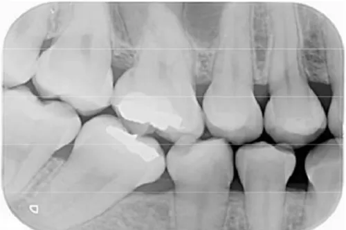 Figura  9.  Radiografia  periapical  póstero-superior esquerda. 