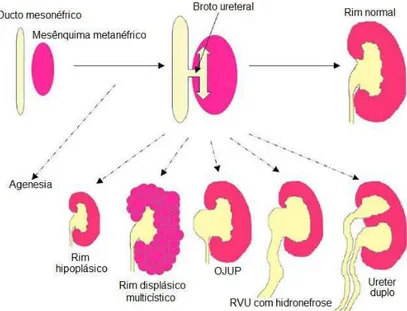 Figura 1: Representação gráfica de algumas malformações renais congênitas. 