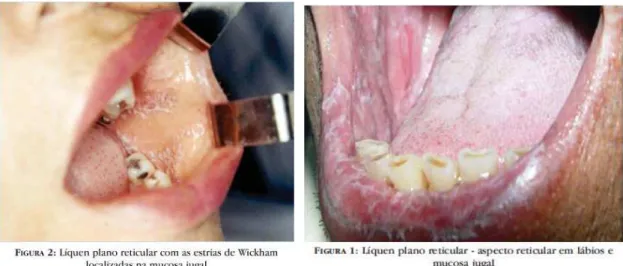 Figura 6 – LPO do tipo reticulado, em duas zonas distintas da mucosa oral (An. Bras. 