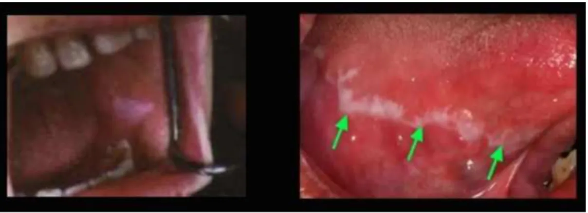 Figura 9 – LPO do tipo erosivo em duas zonas distintas da mucosa oral: mucosa jugal e dorso da língua  (www.google.pt/imagens ) 