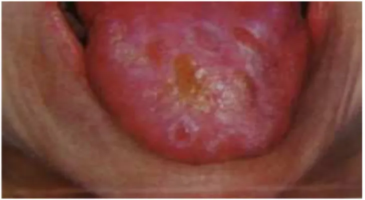 Figura 11 – LPO do tipo bolhoso no dorso da língua (www.google.pt/imagens ) 