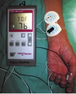 Figure 1.9 - TOF-Watch monitor. (1) Stimulating electrodes applied over ulnar nerve; (2) accelerometer  taped to thumb; (3) display screen [39]