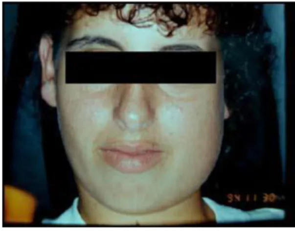 Figura 1 - Especto clínico pré-operatório. Notar assimetria facial do lado esquerdo. 
