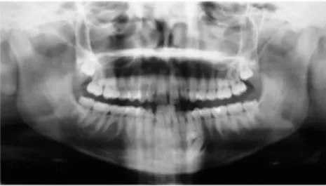 Figura 2  –  Lesão compatível com dentículos na região anterior da mandíbula, associado  a dente canino não irrompido