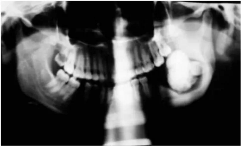 Figura 3 – Radiografia panorâmica: imagem radiopaca envolvendo o ângulo, parte do  corpo e ramo mandibular (odontoma complexo) 