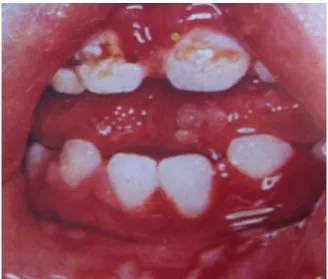 Figura 7. Infeção oportunista associada à falta de higiene oral local. Adaptado de (Elias, 1995)