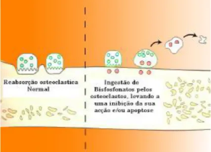 Figura 2. Reabsorção de BP’s pelos osteoclastos. (Adapt: Marx RE. Oral &amp; Intravenous Bisphosphonate-Induced  Osteonecrosis of the Jaws: Quintessence Publishing Co, Inc