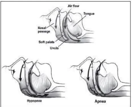 Figura 1 - Anatomia normal e suas variações para obstrução respiratória. (Adaptado de: Wiggert et alii.,  2010)
